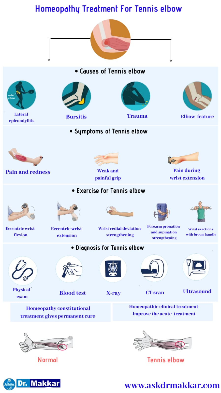Tennis Elbow Lateral Epicondylitis Causes Symptoms